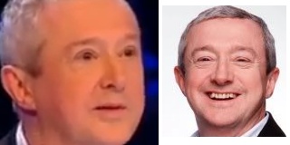louis-walsh-eye-surgery-before-after